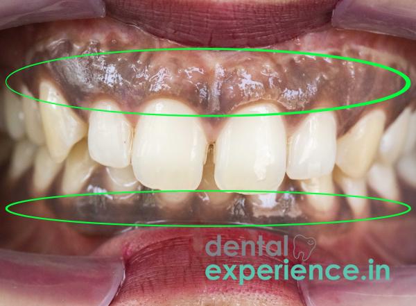 Dark Gums